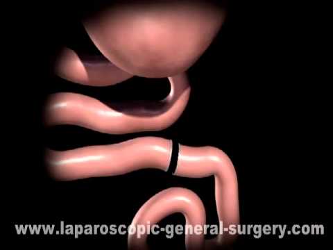 Bariatric Surgery Bangalore |  Best Weight Loss Surgery India
