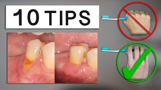 10 Tips to Minimize Gum Recession at Home