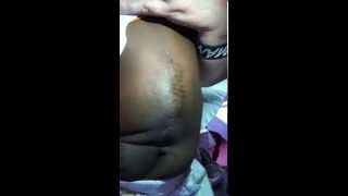 preview picture of video 'Spina Bifida Repair in Kenya'
