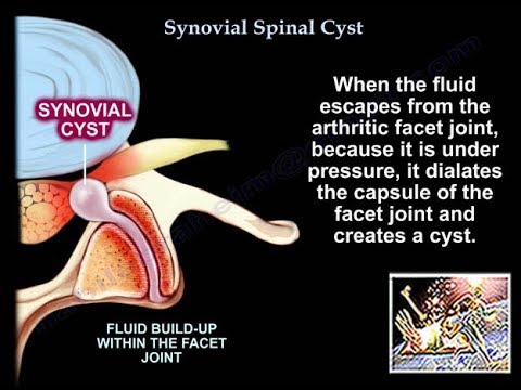 Synovial Cyst Of The Spine - Everything You Need To Know - Dr. Nabil Ebraheim