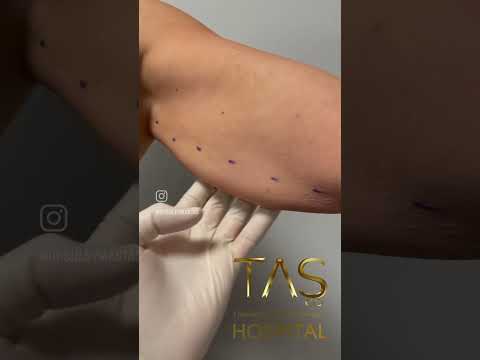 Revolutionary Scarless Arm Lift: Achieve Toned Arms with Dr. TAS