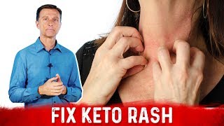Keto Rash is a Vitamin B2 (Riboflavin) Deficiency – Dr.Berg