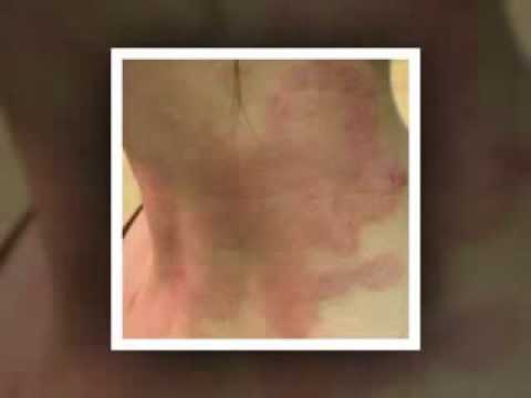 Fosfogliv allatto di cura di psoriasi Betulla in cura di psoriasi