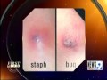 Bug Bites vs. Staph Infections