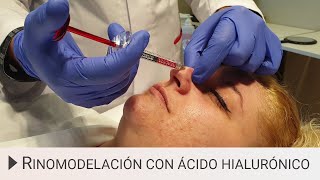 👃 Rinomodelación con Ácido Hialurónico - Sin cirugía
