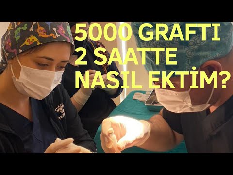  How I Planted 5000 Grafts in 2 Hours Dr.Kinyas New DHI