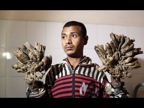 "Tree Man" Doesn't Look Like This Anymore...