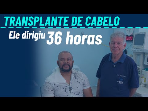 Transplante capilar em paciente do Alagoas