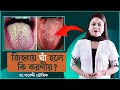 জিহ্বায় ঘাঁ হলে কি করণীয় || Tongue ulcer treatment || Dr. Shatabdi Bhowmik