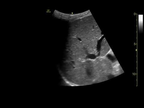 Point-of-care ultrasound diagnosis of pneumoperitoneum