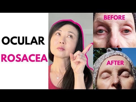 Ocular Rosacea Before and After