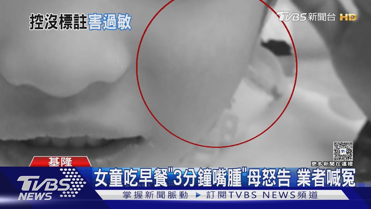 獨家影音／女童吃燒餅「3分鐘臉腫嘴外翻」！母怒告早餐店　業者喊冤