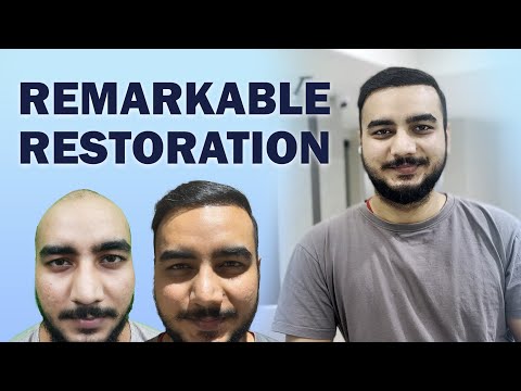 A Remarkable Hair Restoration Journey in Bangalore -...