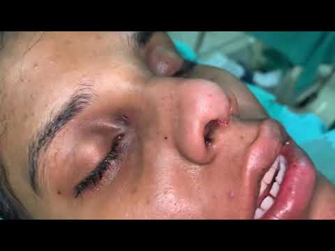 Video Of Rhinoplasty