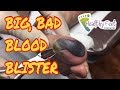 The Best 29 Dried Blood Under Skin On Foot