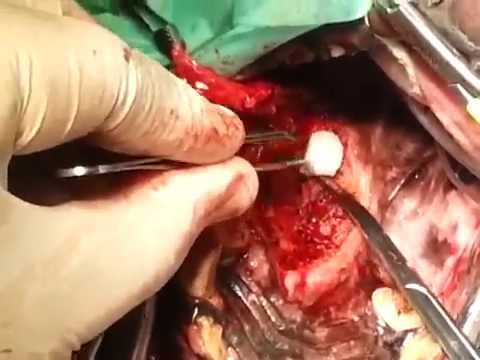 Dieta nel trattamento del cancro alla prostata Cerotto cinese di prostatite Almaty