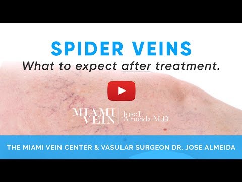 Spider Veins "What to Expect After Treatment" by the Miami Vein Center