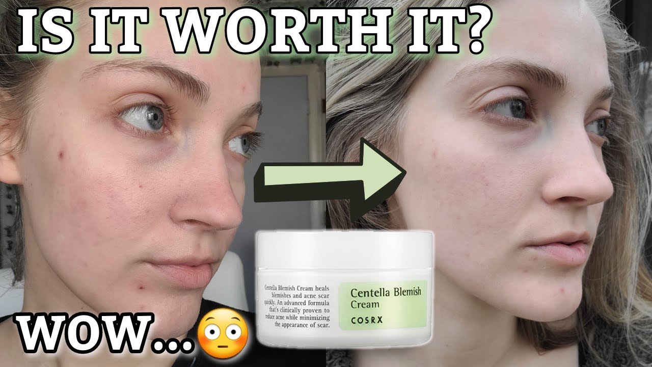 Watch video COSRX Centella Blemish Cream Review | Testing The COSRX Blemish Cream For 10 Days Now COSRX Centella Blemish Cream Review | Testing The COSRX Blemish Cream For 10 Days