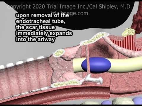Endotracheal Intubation Complications: Subglottic Stenosis and Laryngeal Edema by Cal Shipley, M.D.