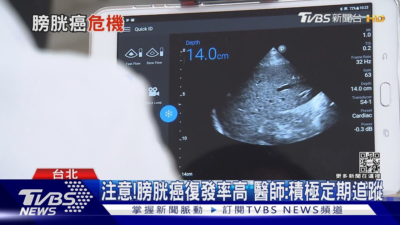 經常有這習慣的人罹「膀胱癌」風險增30% 水喝太少、頻尿要小心!