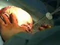 Baby Born: Cesarean Delivery