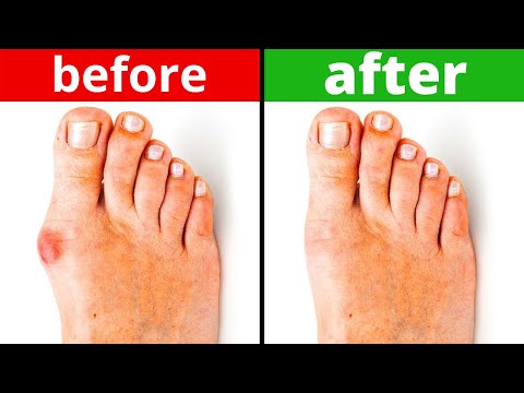 Removes uric acid! Straightens the foot bone.💯 Stop Gout. Grandma's old recipe🔥🔥🔥