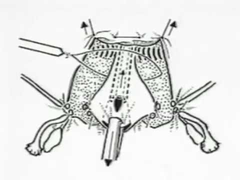 Laparoscopic hysterectomy by Kurt Semm