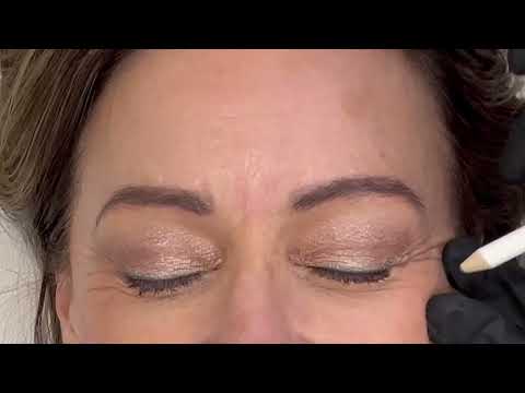 Botox: Are You Team Love or Team Hate?