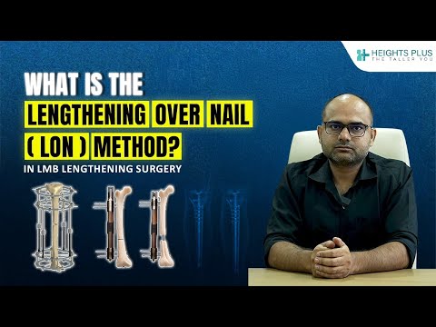 LON Method in Limb Lengthening Surgery क्या है और कैसे होती है? | Heights Plus