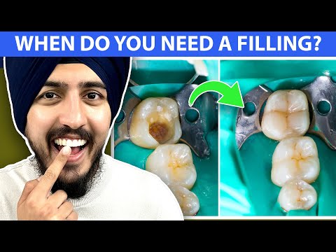 When Do You NEED A Dental Filling? Dentist Explains