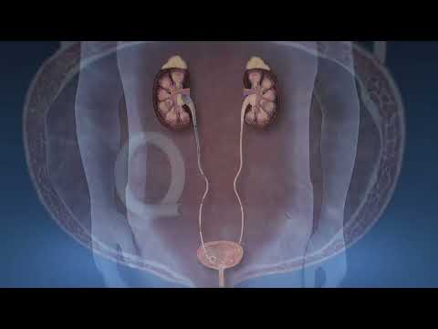 Kidney Stone PCNL Stent
