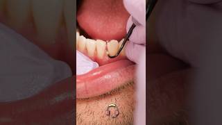 ASMR teeth scaling at the dentist #shorts
