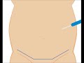 Tummy Tuck