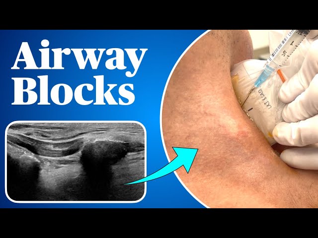 Airway Blocks for Awake Intubation Airway Blocks for Awake Intubation