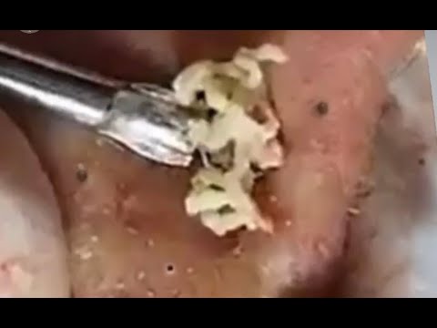 Big Blackest Blackheads! Pimple Popping with Gloves Microscope