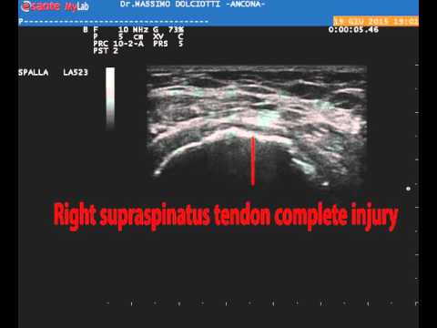 Nuga Miglior letto con osteocondrosi cervicale Articolazioni doloranti provoca gamba