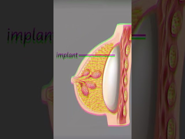 Implants and Kids