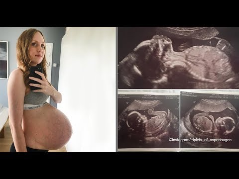 Cette femme est enceinte de triplés🤰et a eu un impact en raison de la taille de son ventre😱 Video