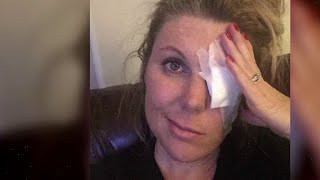 VIDEO: What is Bell&#39;s palsy? Symptoms, treatment and recovery