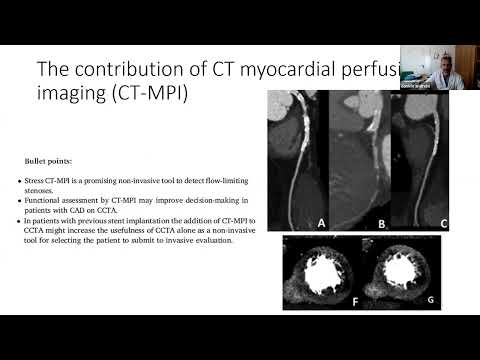 Expert consensus review: Pre-procedural planning of coronary revascularization by cardiac CT