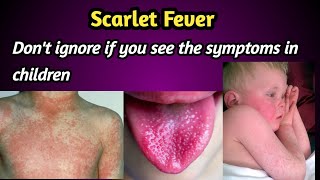 Scarlet Fever Symptoms and Treatment.