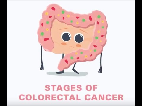 5 Stages of Colorectal Cancer Explained | Parkway Cancer Centre