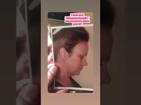Watch Video: #1WeekFollowUp Deep Plane Neck & Facelift