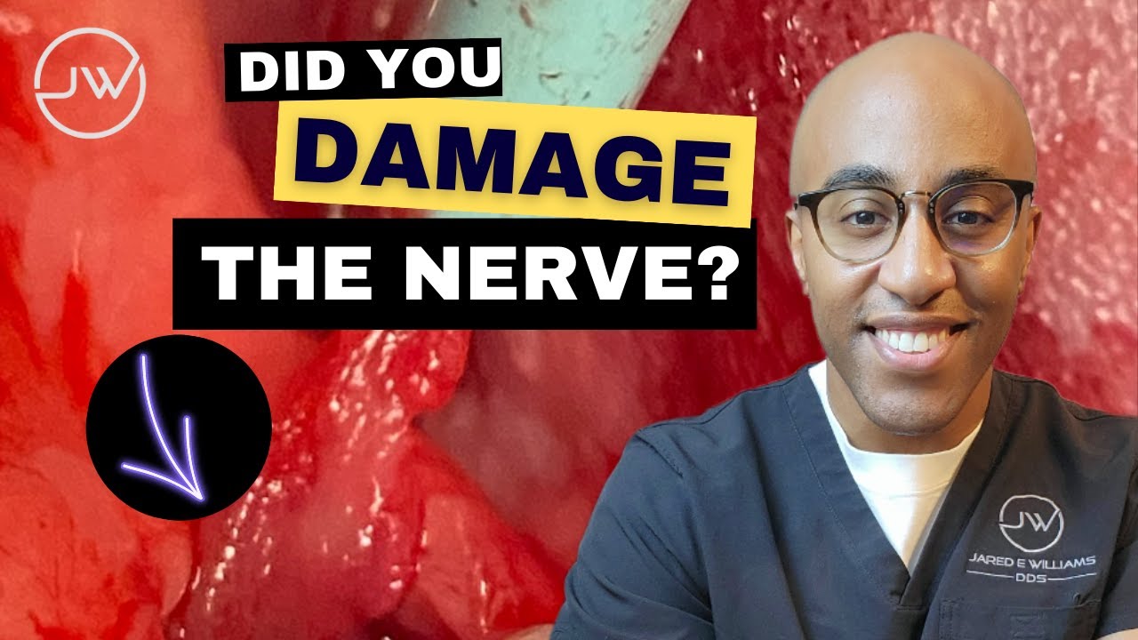 Does nerve pain go away after tooth extraction? More REF