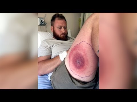 N.S. man recovering from suspected brown recluse spider bite