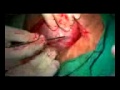 cesarean birth - C Section - LSCS 