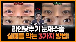 당신의 눈재수술이 또 실패하는 이유, 이 3가지 때문입니다