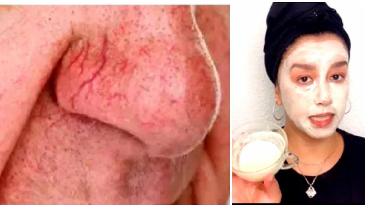 Watch Cómo eliminar las venas rojas del rostro Now Cómo eliminar las venas rojas del rostro