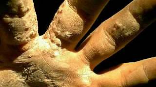 clip the apex (incomplete)