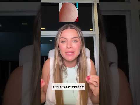 WHAT IS THE BEST TREATMENT FOR STRETCH MARKS?